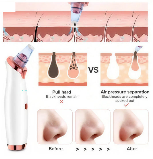Vacuum Blackhead Remover Face Black Spots Cleaner White Dot Pimple Removal
